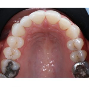 Post-treatment after completing Invisalign treatment and whitening with Boutique Whitening