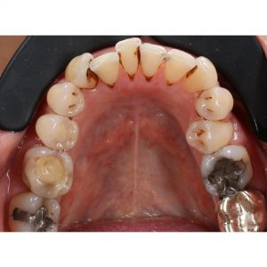 Pre-Treatment Lower Arch